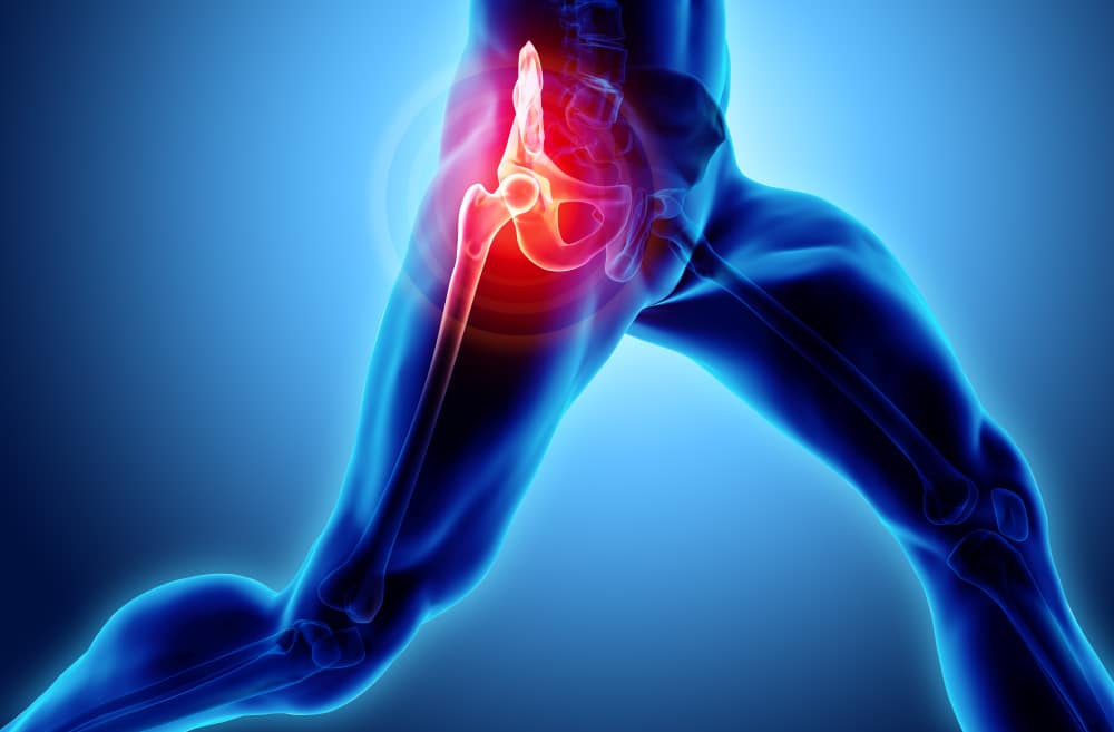 3d,Illustration,,Hip,Painful,Skeleton,X-ray,,Medical,Concept. 1763657052 83f1e35537334c7a9ec60a820bb1e48c 1 Hip Surgery Specialist in East Brunswick, NJ